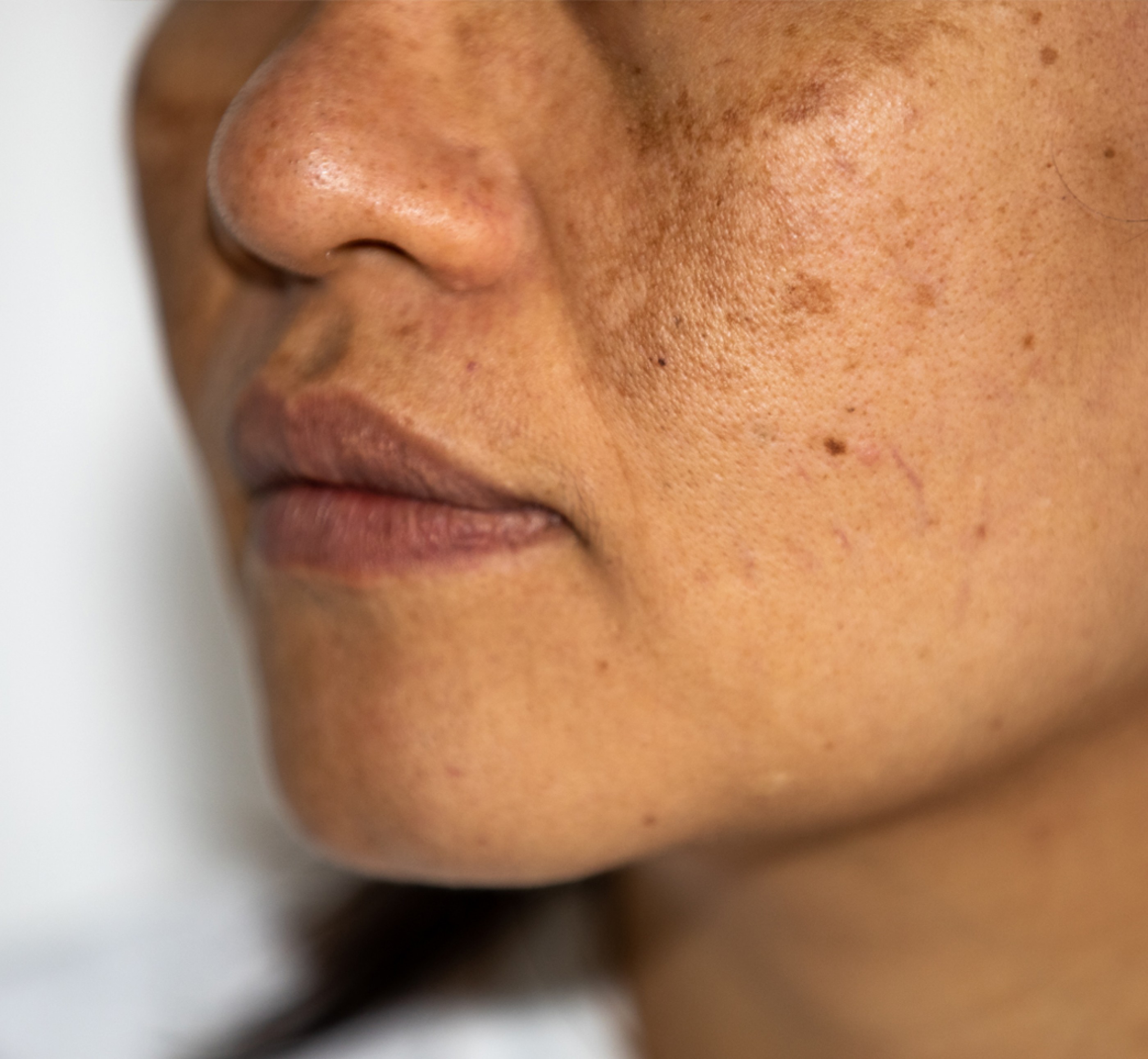 Pigmentation Disorders