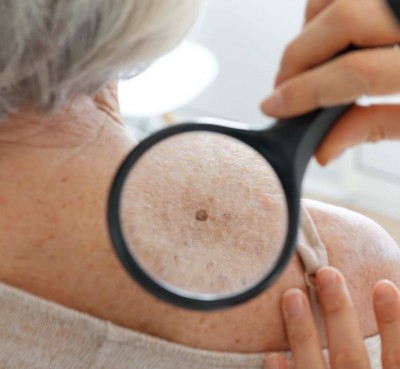 Skin Cancer Screening