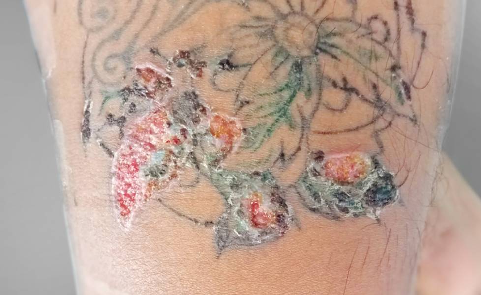 7 SKIN REACTIONS TO TATTOOS