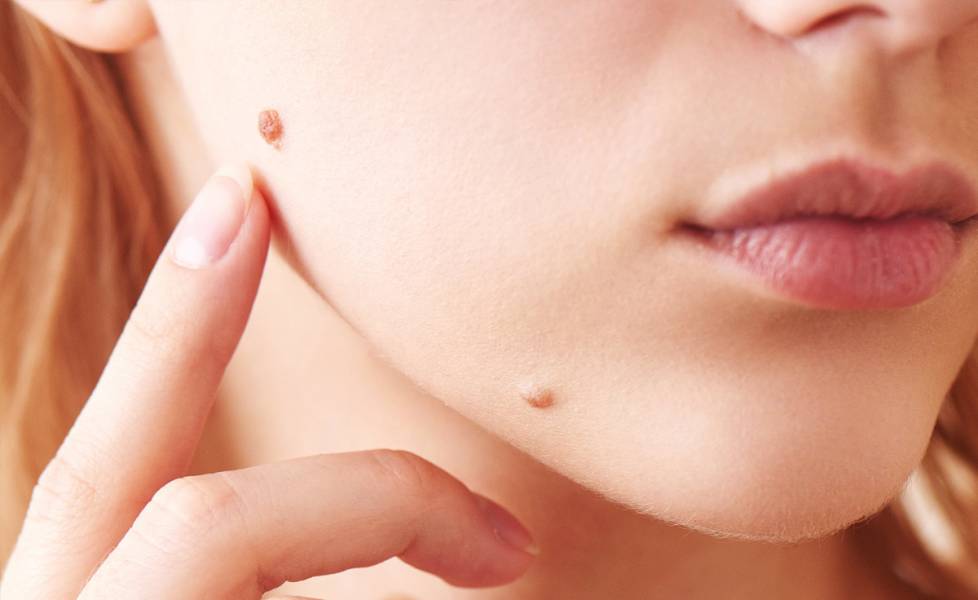 Skin Cancers Can Give You A Chance