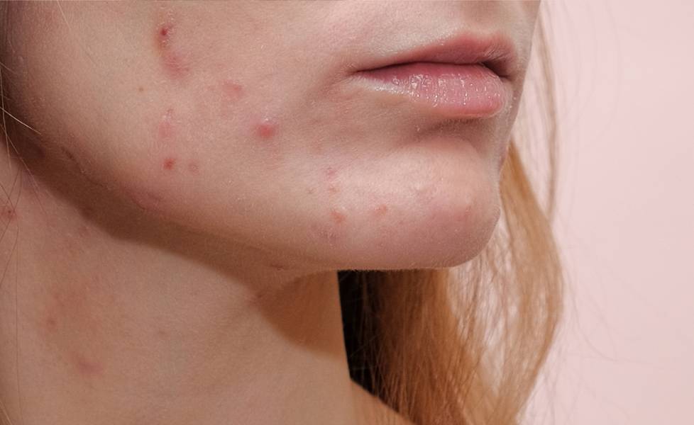 Acne, Rosacea, Seborrhea - OH MY!