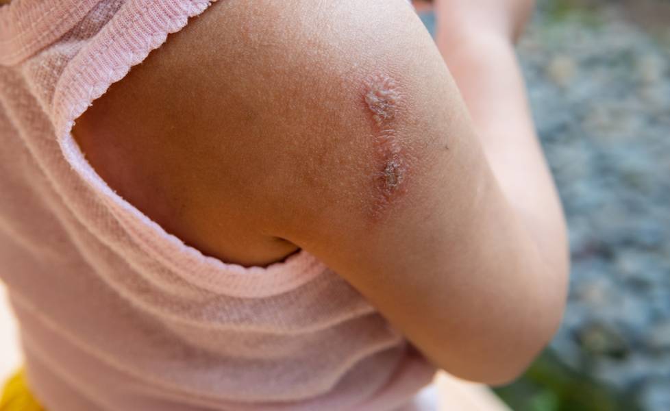 Impetigo: Understanding the Causes, Symptoms, and Treatment of This Common Skin Infection