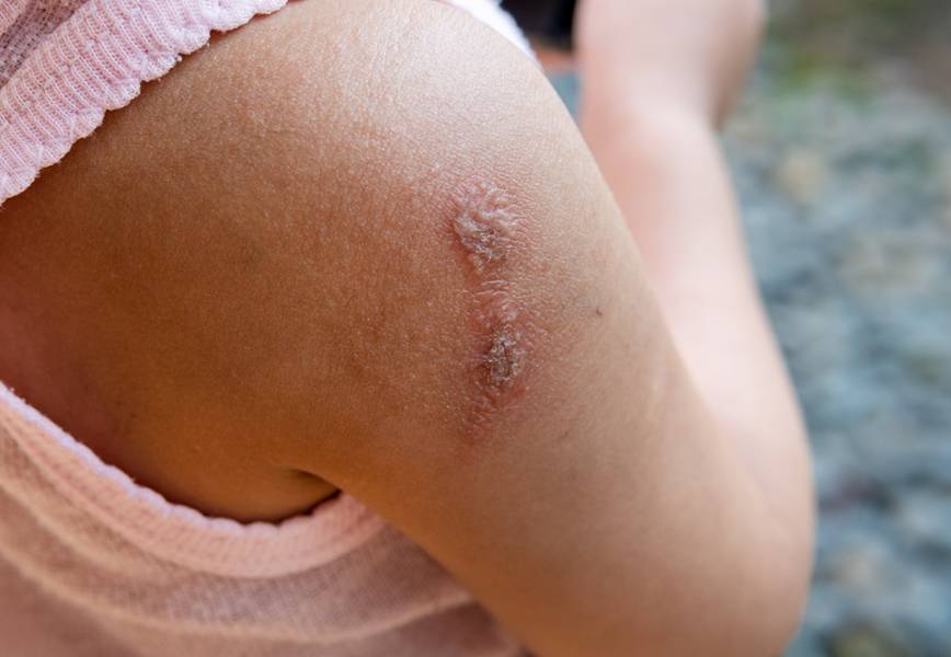 Impetigo: Understanding the Causes, Symptoms, and Treatment of This Common Skin Infection